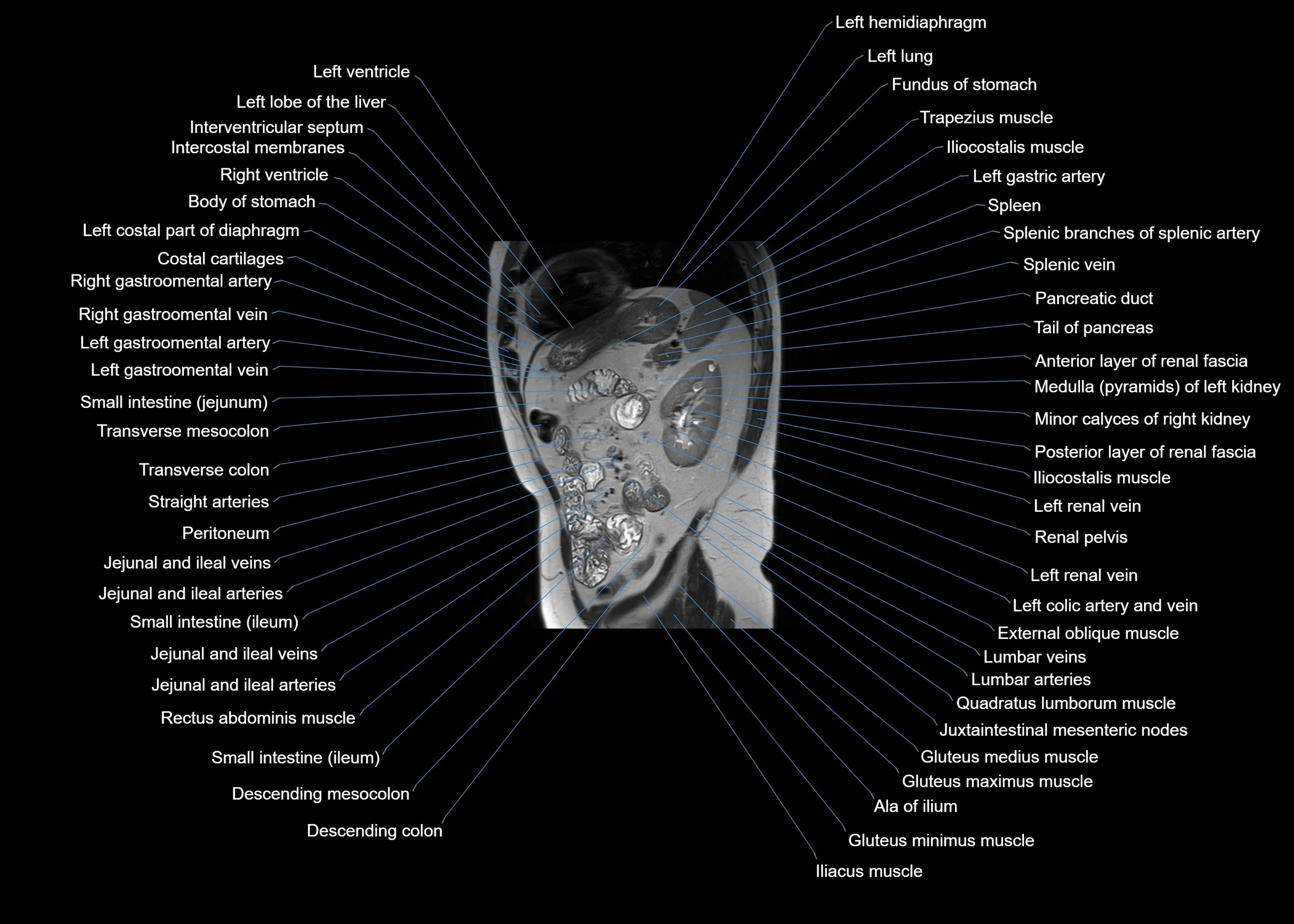 MRI abdomen sagittal cross sectional anatomy  radiology  image-img-00001-00050.webp